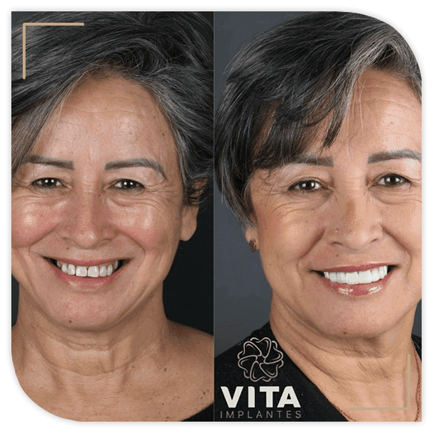 Resultado de implante dentário em paciente da Clínica Vita Implantes, em Goiânia